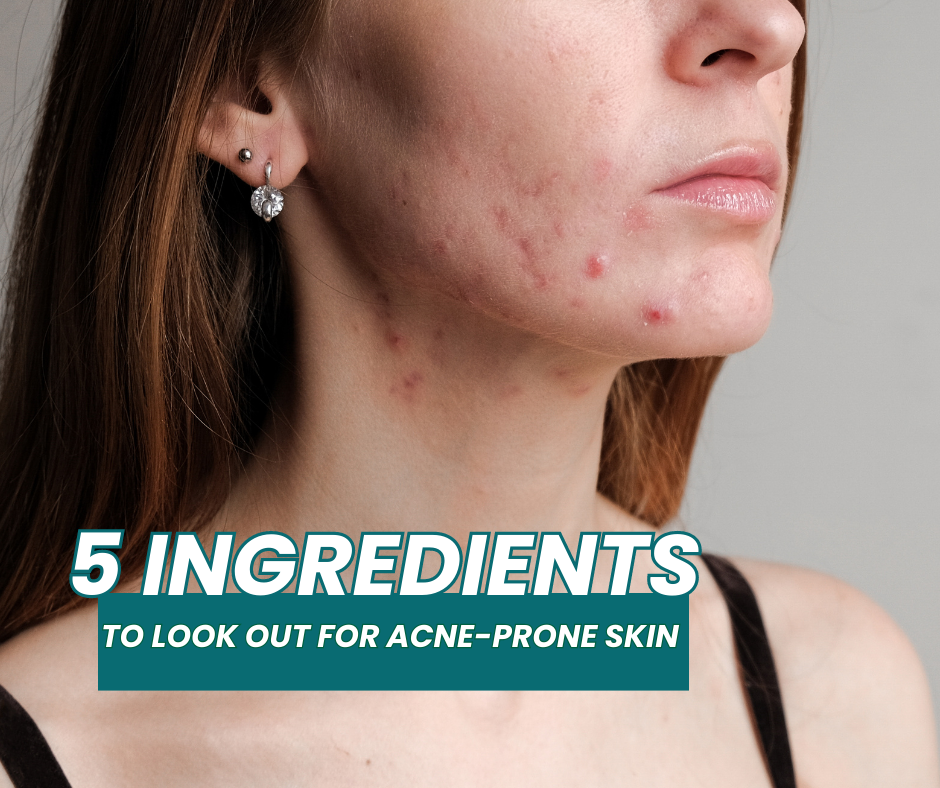 5 Ingredients To Look Out For Acne-Prone Skin