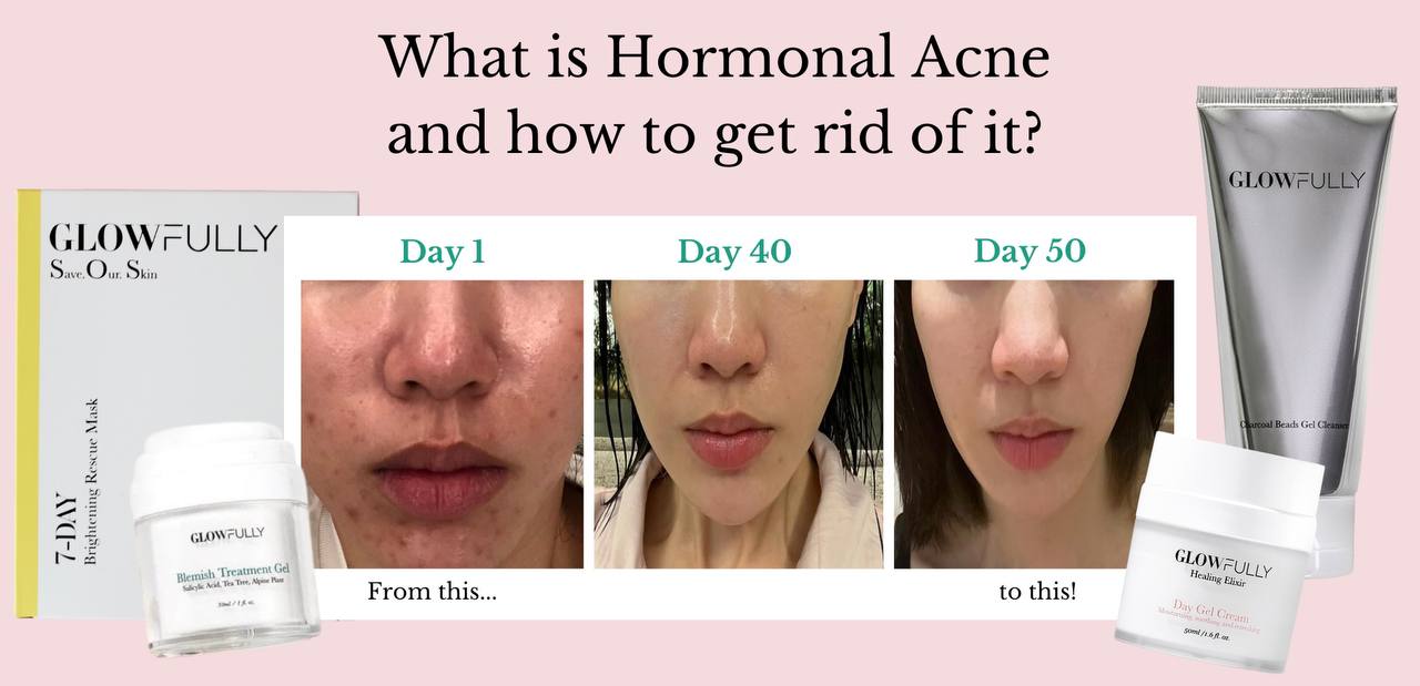 Understanding Hormonal Acne Across Different Life Stages