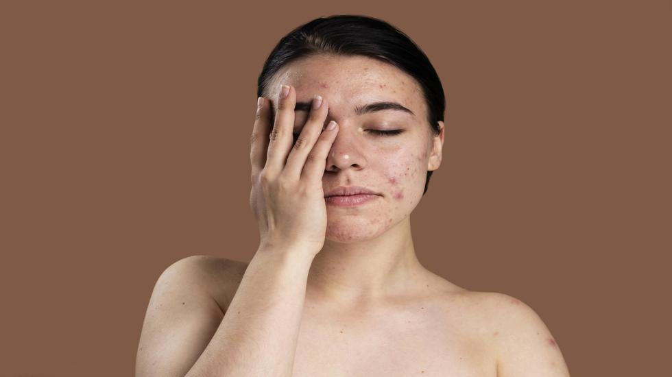 How hormones affect your skin before and during a period?